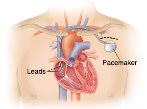 Pacemaker Insertion- Transvenous | Spectrum Health Lakeland