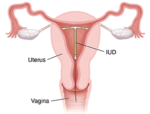 Birth Control: IUD (Intrauterine Device) | Spectrum Health Lakeland