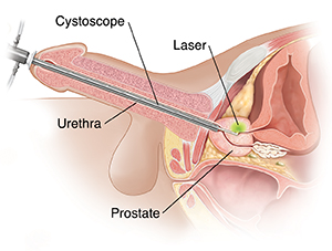 Laser Prostatectomy | Spectrum Health Lakeland
